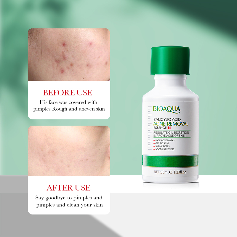 35ml BIOAOUA Salicylic Acid An – Azelaic Acid Serum recenzja i cena