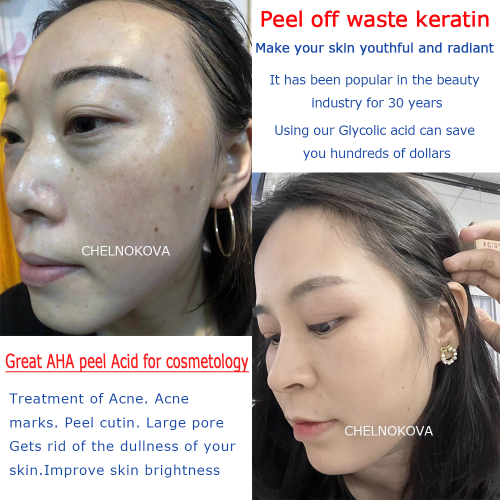 Citric acid 20% 30% 40% 50% pe – Skincare Exfoliating recenzja i cena