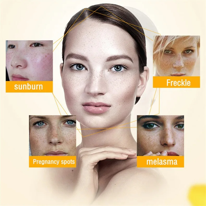 Whitening Freckle Cream Remove – Skincare Glowing recenzja i cena