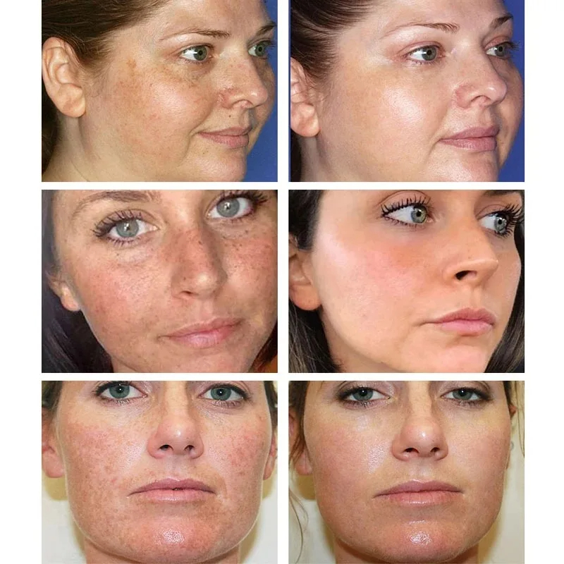 Whitening Freckle Cream Remove – Skincare Glowing recenzja i cena